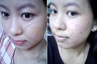 Cách trị mụn bằng thuốc bắc hết mụn bọc, mụn mũ của Khách hàng TN18016